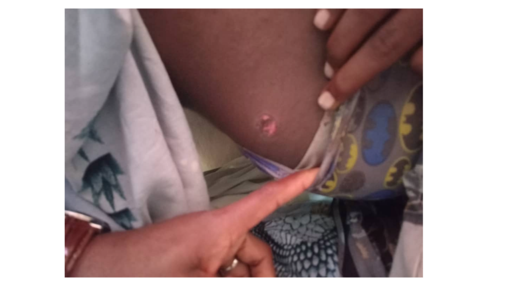 Mogadishu police kill 6 civilians in Dayniile: An injured boy shows a bullet wound to his hand in Mogadishu.